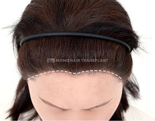 M-shaped forehead incision hair transplant after
