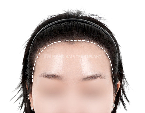 Angular forehead incision hair transplant after