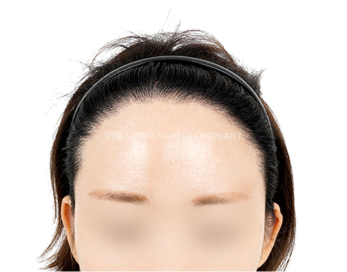 Wide forehead incision hair transplant after