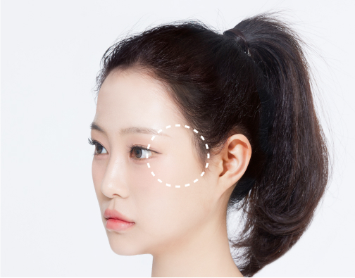 Non-incisional hair transplant after