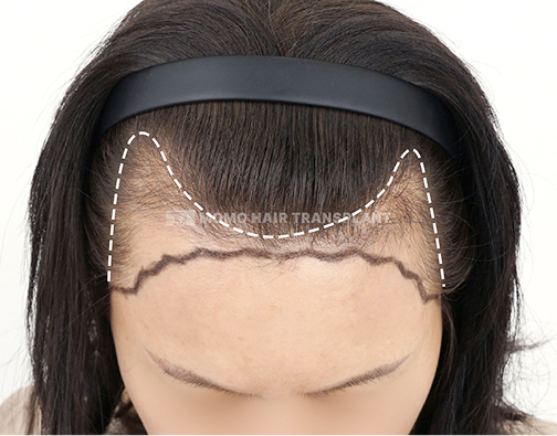 M-shaped forehead incision hair transplant before