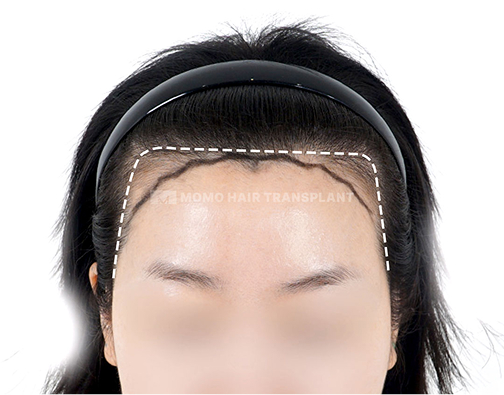 Angular forehead incision hair transplant before