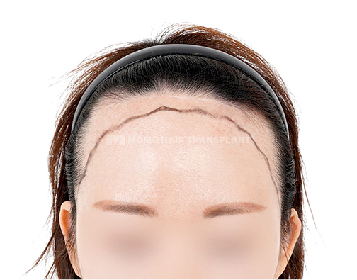 Wide forehead incision hair transplant before
