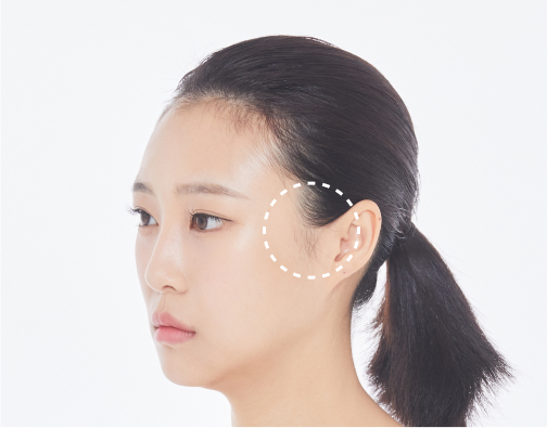Non-incisional hair transplant before