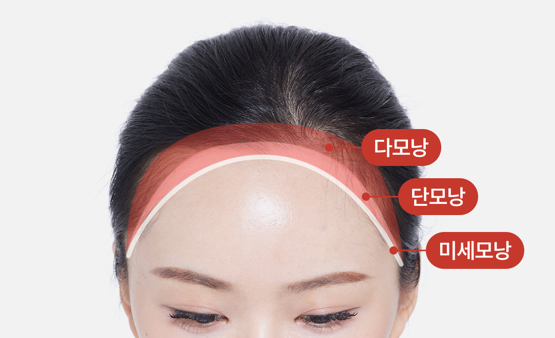 Forehead gradation transplant