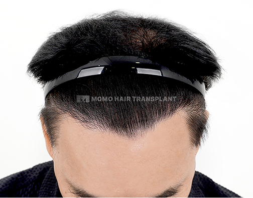 Male Incision Hair Transplant after