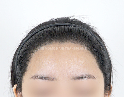 Female Incision Hair Transplant after