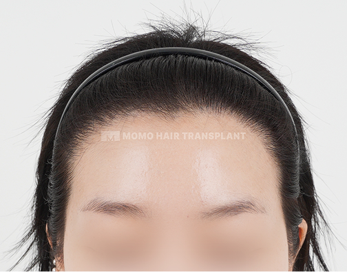 Female Incision Hair Transplant after