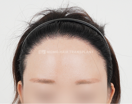 Female Incision Hair Transplant after