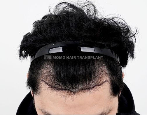 Male Incision Hair Transplant before