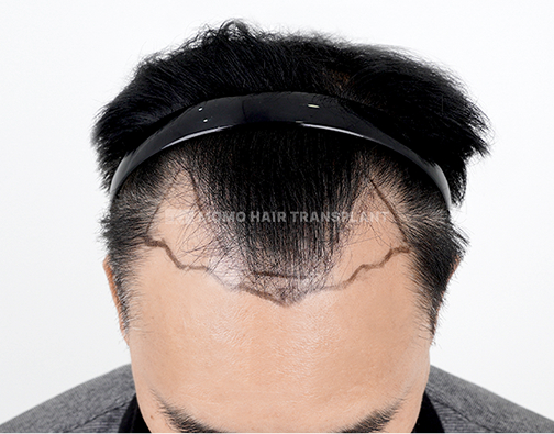 Male Incision Hair Transplant before