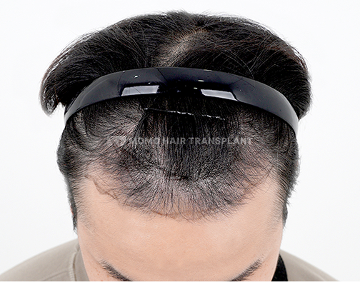 Male Incision Hair Transplant before
