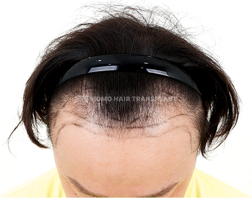 Male Incision Hair Transplant before
