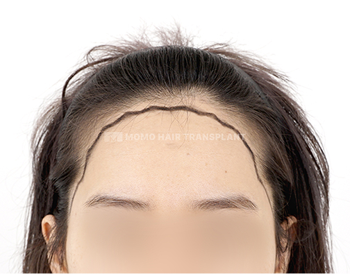 Female Incision Hair Transplant before