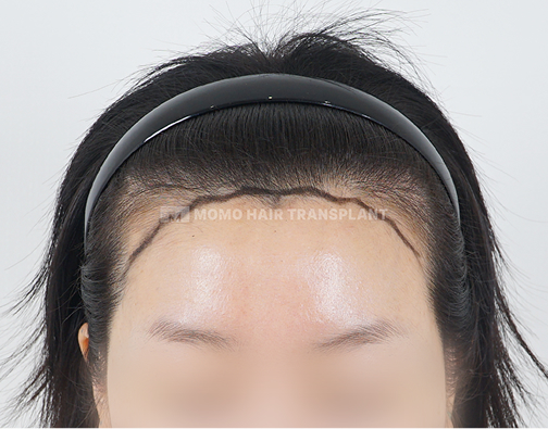 Female Incision Hair Transplant before