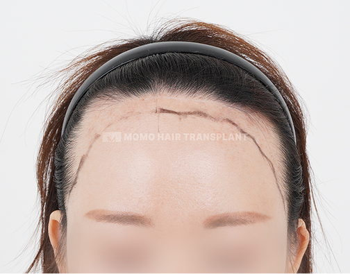 Female Incision Hair Transplant before