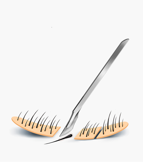 Incision hair transplant surgical method