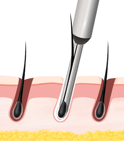 Incision hair transplant surgical method