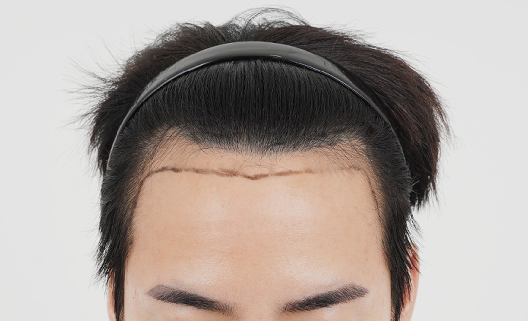 Hairline Design