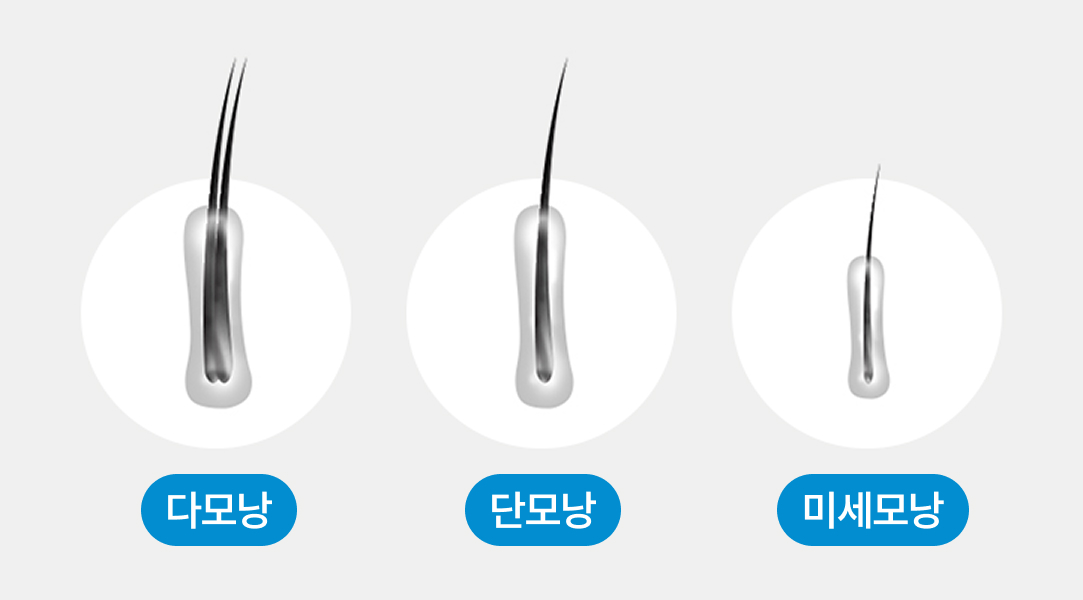 Forehead Gradation Transplant