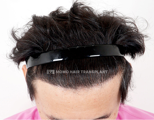 Male non-incisional hair transplant after