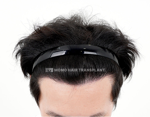Male non-incisional hair transplant after