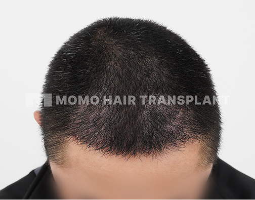 Male non-incisional hair transplant after
