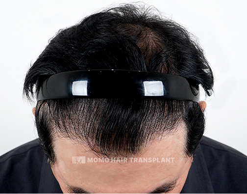 Male non-incisional hair transplant after