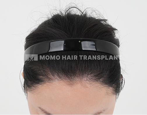 Female non-incisional hair transplant after