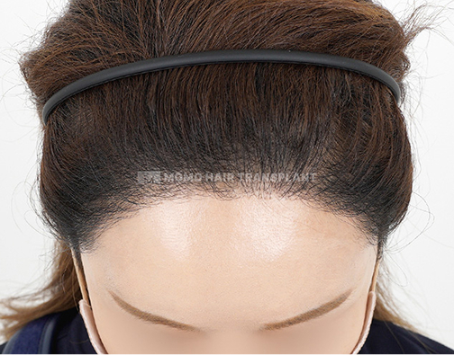 Female non-incisional hair transplant after