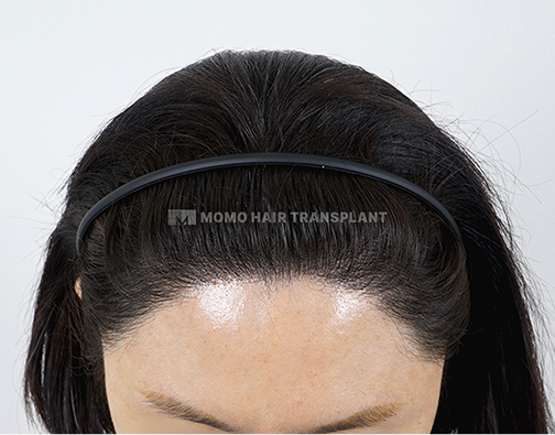 Female non-incisional hair transplant after