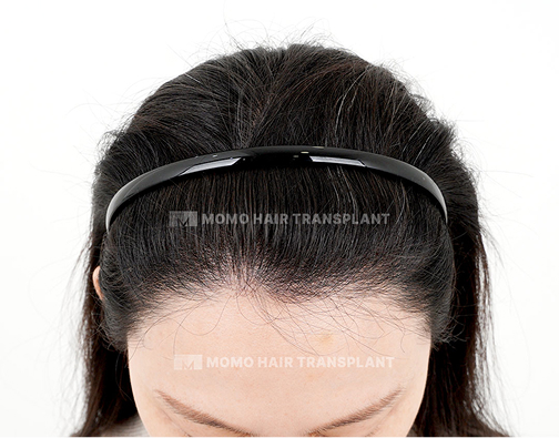 Female non-incisional hair transplant after
