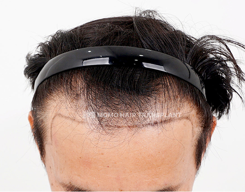 Male non-incisional hair transplant before
