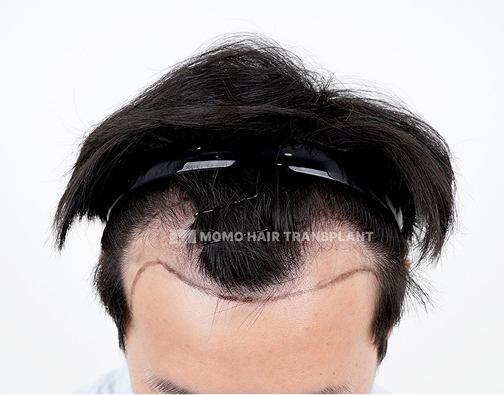Male non-incisional hair transplant before