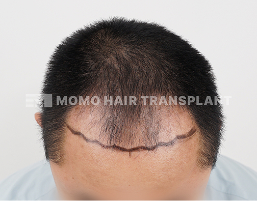 Male non-incisional hair transplant before