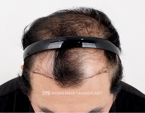 Male non-incisional hair transplant before