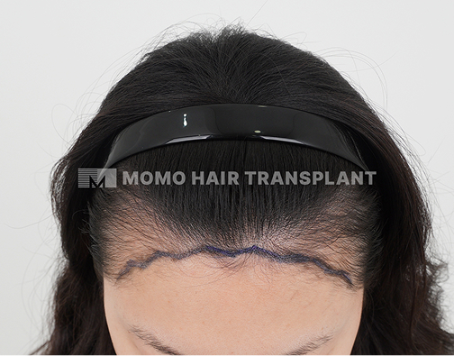 Female non-incisional hair transplant before