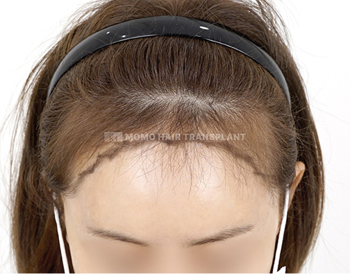 Female non-incisional hair transplant before