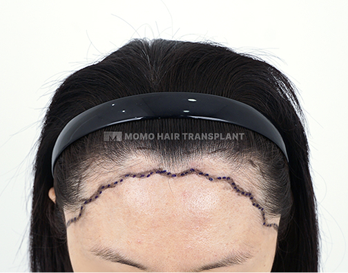 Female non-incisional hair transplant before