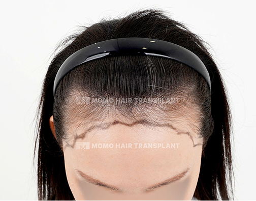 Female non-incisional hair transplant before