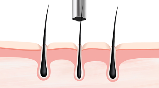 Harvesting vellus hair