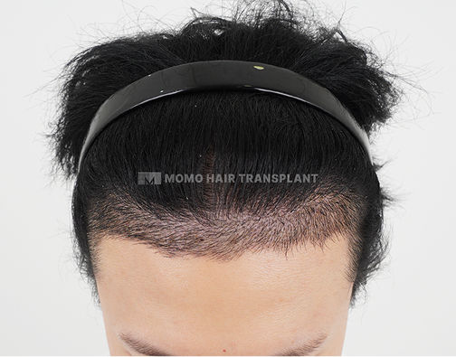 Male FUE hair transplant after