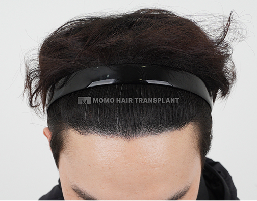 Male FUE hair transplant after