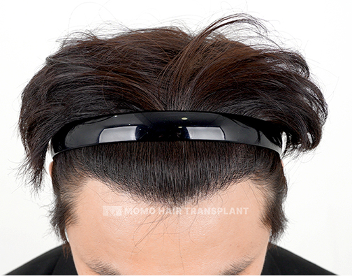Male FUE hair transplant after