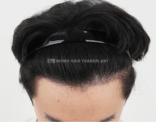Male FUE hair transplant after