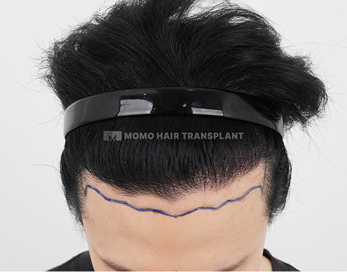 Male FUE hair transplant before