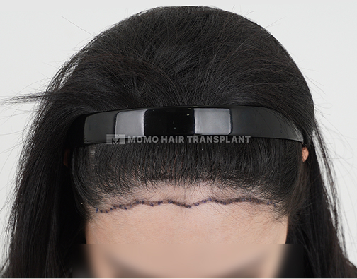 Male FUE hair transplant before