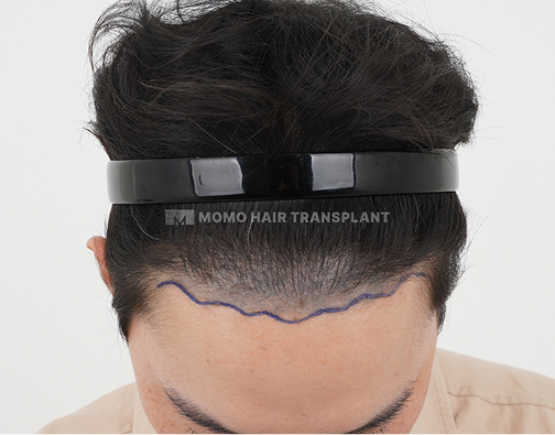 Male FUE hair transplant before