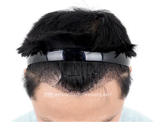 Male FUE hair transplant before