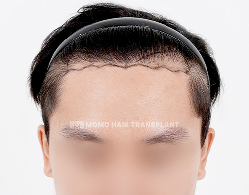 Male FUE hair transplant before